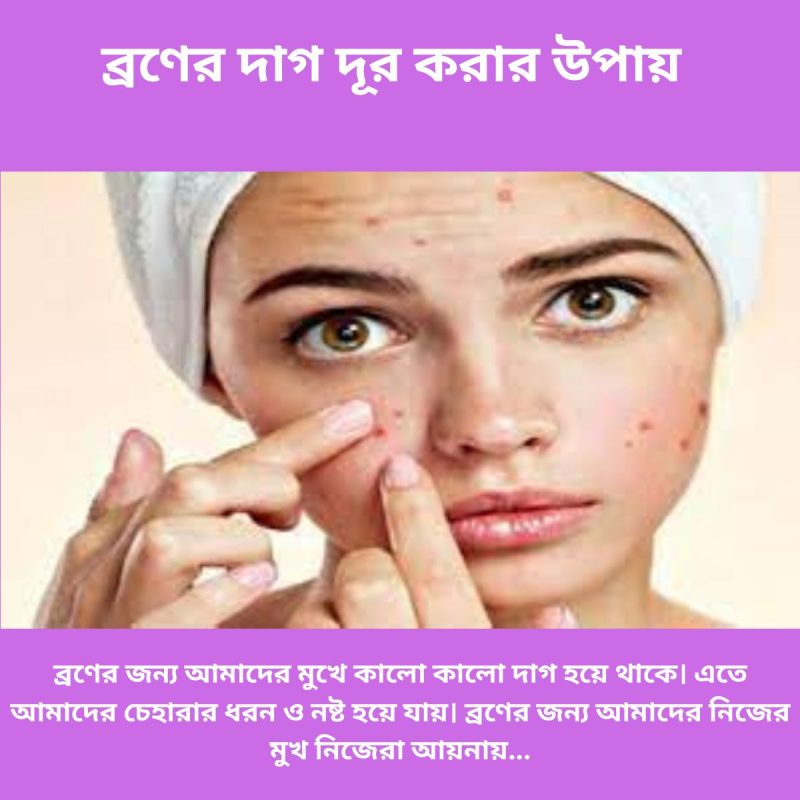 ব্রণের দাগ দূর করার উপায়